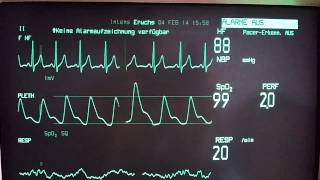 Ventricular Extrasystoles [upl. by Aicirtam]