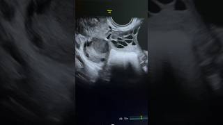 Kissing ovaries bilateral endometriosis ultrasound ARDMS sonography obgyn [upl. by Anissej797]