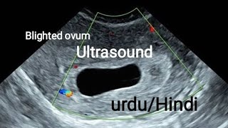 Blighted OvumAnembryonic Pregnancy on ultrasound [upl. by Gae]