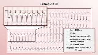 Intro to EKG Interpretation  Practicing Tachyarrhythmia Identification [upl. by Dwan]