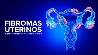 Fibromas Uterinos  Qué son cómo se diagnostican y cómo se tratan [upl. by Annaul]