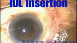 Extracapsular cataract extraction [upl. by Dixie]