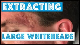 Acne Vulgaris and Extracting large Whiteheads  Part 1 [upl. by Kathryn]