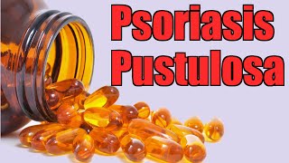 Psoriasis Pustulosa 3 Tratamientos Naturales Muy Efectivos [upl. by Tobey]