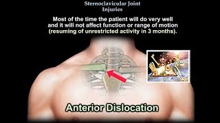 Sternoclavicular Joint Injuries  Everything You Need To Know  Dr Nabil Ebraheim [upl. by Malha]