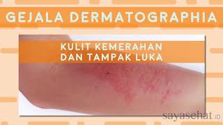 Dermatographia [upl. by Bierman]