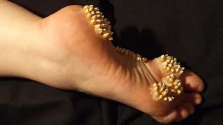 Agnikarma in Foot corn Medicinal cauterization by Ayurveda method [upl. by Norvun280]