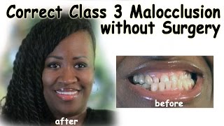 Correct Class 3 Malocclusion without Surgery  Bergen County NJ Dentist [upl. by Htur]