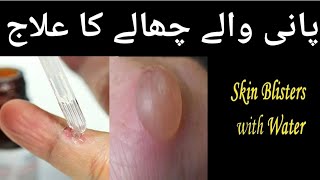 Pani wale dano ka ilaj  skin blisters with water پانی والے چھالے کا علاج [upl. by Thompson268]