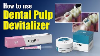 How to use Dental Pulp Devitalizer  Waldent Devital [upl. by Morry870]