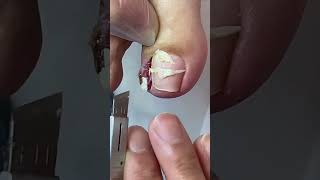 Ep7 How many times have you seen paronychia like this Ingrown toenail treatment [upl. by Norabel]