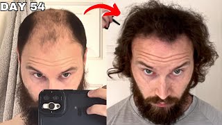 BALDING HAIR GROWTH For 15 Years  Reviewed [upl. by Ideih]