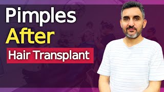 Pimples after Hair Transplant [upl. by Naujet876]