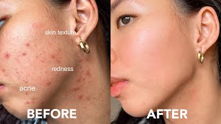 How To Calm Down Sensitive Skin • Irritation • Postacne  Cica Madecassoside Creams [upl. by Zetnahs]