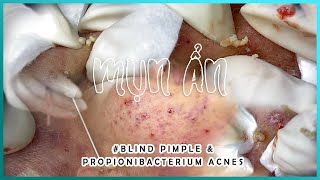 Big Cystic Acne Blackheads Extraction Blackheads amp Milia Whiteheads Removal Pimple Popping [upl. by Oringas]