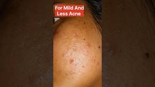 how to treat acne pimples azelaic acid or glocin gel which is better acnetreatment azelaicacid [upl. by Solis]