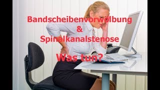 Spinalkanalstenose und Bandscheibenvorfall ohne OP [upl. by Deerc]