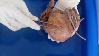 Urinary bladderAnatomyDissection videomalayalam [upl. by Anidem872]