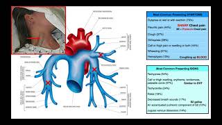 Wells Criteria for Pulmonary Embolisms PEs EXPLAINED [upl. by Winser]