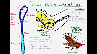 Forceps vs Vacuum Extraction Delivery Ventouse Understanding the Difference Procedures and Risks [upl. by Augy]