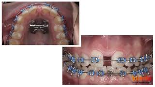 Evolución del tratamiento de ortodoncia con brackets en menos de 1 minuto [upl. by Bilicki]