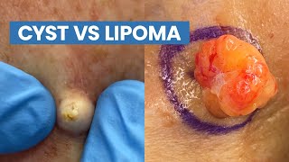 Cyst vs Lipoma Short Pops Compilation  CONTOUR DERMATOLOGY [upl. by Miof Mela658]