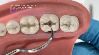 Base application Resinmodified glass ionomer cement in the deepest part of the cavityArabic عربي [upl. by Inverson]