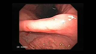 Video clip of an Upper Endoscopy [upl. by Aerdua]