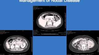 Outcomes for patients with locally advanced renal cell carcinoma Christopher G Wood MD UT [upl. by Gleda]