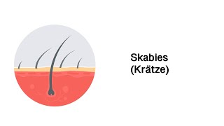 Skabies Krätze  Erkrankungen der Haut [upl. by Foy390]