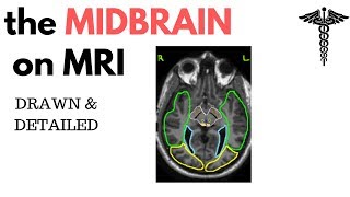 Neuroanatomy on MRI Part 2  Hypothalamus amp Midbrain tectum tegmentum amp floor [upl. by Falda973]