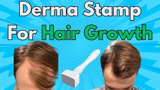 This Is Why You Should Add A Derma Stamp To Your Hair Growth Routine  Derma Stamp x Minoxidil Combo [upl. by Yrekcaz960]