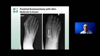 Bunionectomy Find the Right Approach for You wDr Michael Clain [upl. by Aretahs]