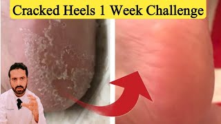 Cracked Heels 1 Week Solution  Quick Cracked Heel Treatment [upl. by Navets]