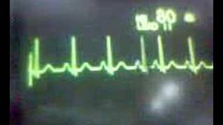 ECG Video Normal sinus rhythm [upl. by Erodasi1]