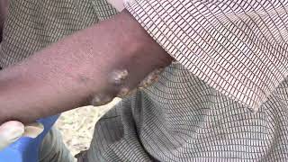 WRONG jigger treatments damaged Wafulas feet  subscribe net to see full vids [upl. by Gerg720]