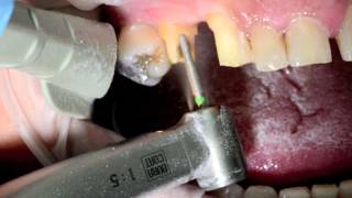 Emax Cad Cerec Brigde Full clinical case in PAG technique c Dr J Raynal [upl. by Adnamor]