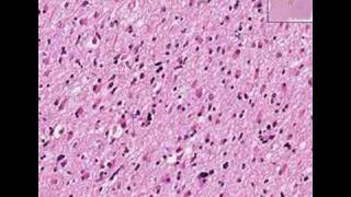 Histopathology BrainAstrocytoma [upl. by Radie]