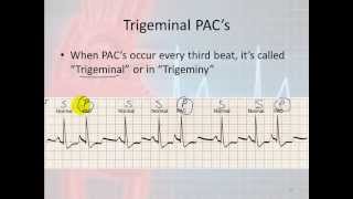 Basic Electrophysiology part 7  Atrial Rhythms part 1 Introduction and PACs [upl. by Novyar]