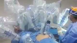 Robotic Rectal Cancer Surgery [upl. by Trish]