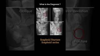 Scaphoid fracture  Scaphoid series 141Trauma Xray  Upper limb gallery 2radiologychannel007 [upl. by Araz]