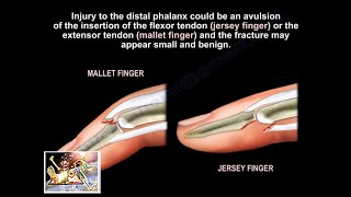 Mallet and Jersey Fingers Description Everything You Need To Know  Dr Nabil Ebraheim [upl. by Oniliuqnart]