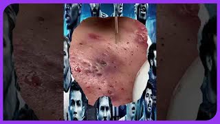 Blackhead Removal and Acne Treatment Satisfying Extraction 2024 [upl. by Baily]