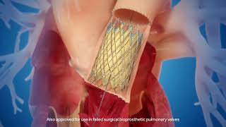 Melody™ Transcatheter Pulmonary Valve animation [upl. by Wahs442]