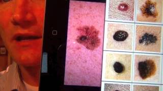 Mole vs Melanoma [upl. by Aimaj920]