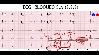 ECG BRADIARRITMIAS  Disfunción del Nodo Sinusal SSS  PARTE 3 [upl. by Jereld]