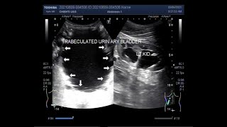 A trabeculated urinary bladder with bilateral renal dilated pelvicalyceal System [upl. by Torp]