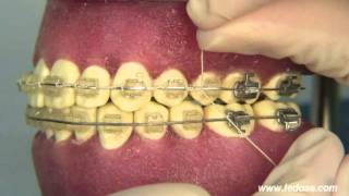 ORTOCERVERA  Ortodoncia Ligadura continua trenzada [upl. by Clapp]