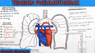 tension pneumothorax in Hindi [upl. by Harriman]