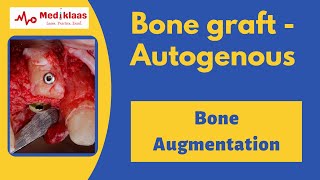 Autogenous Bone Grafts [upl. by Reltuc]